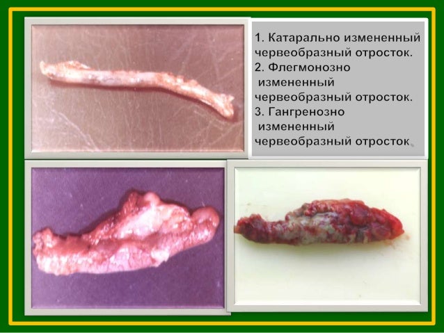 о. аппендицит