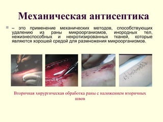 Механическая антисептика
 – это применение механических методов, способствующих
удалению из раны микроорганизмов, инородных тел,
нежизнеспособных и некротизированных тканей, которые
являются хорошей средой для размножения микроорганизмов.
Вторичная хирургическая обработка раны с наложением вторичных
швов
 