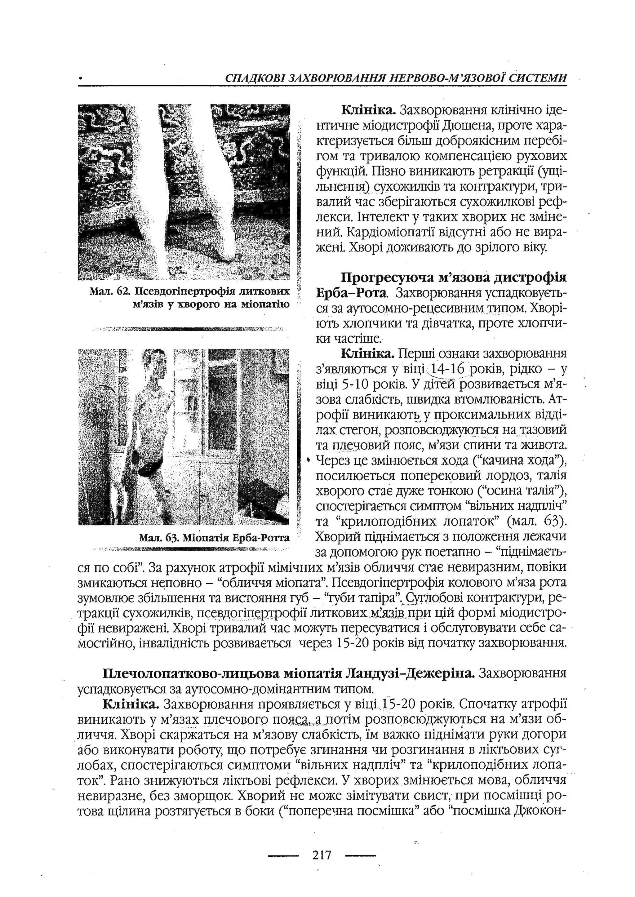 медсестринство в неврології за ред. В.М. Пашковський, І.І. Кричун, І.І. Кривецька, І.Я. ст.254 , 2003р