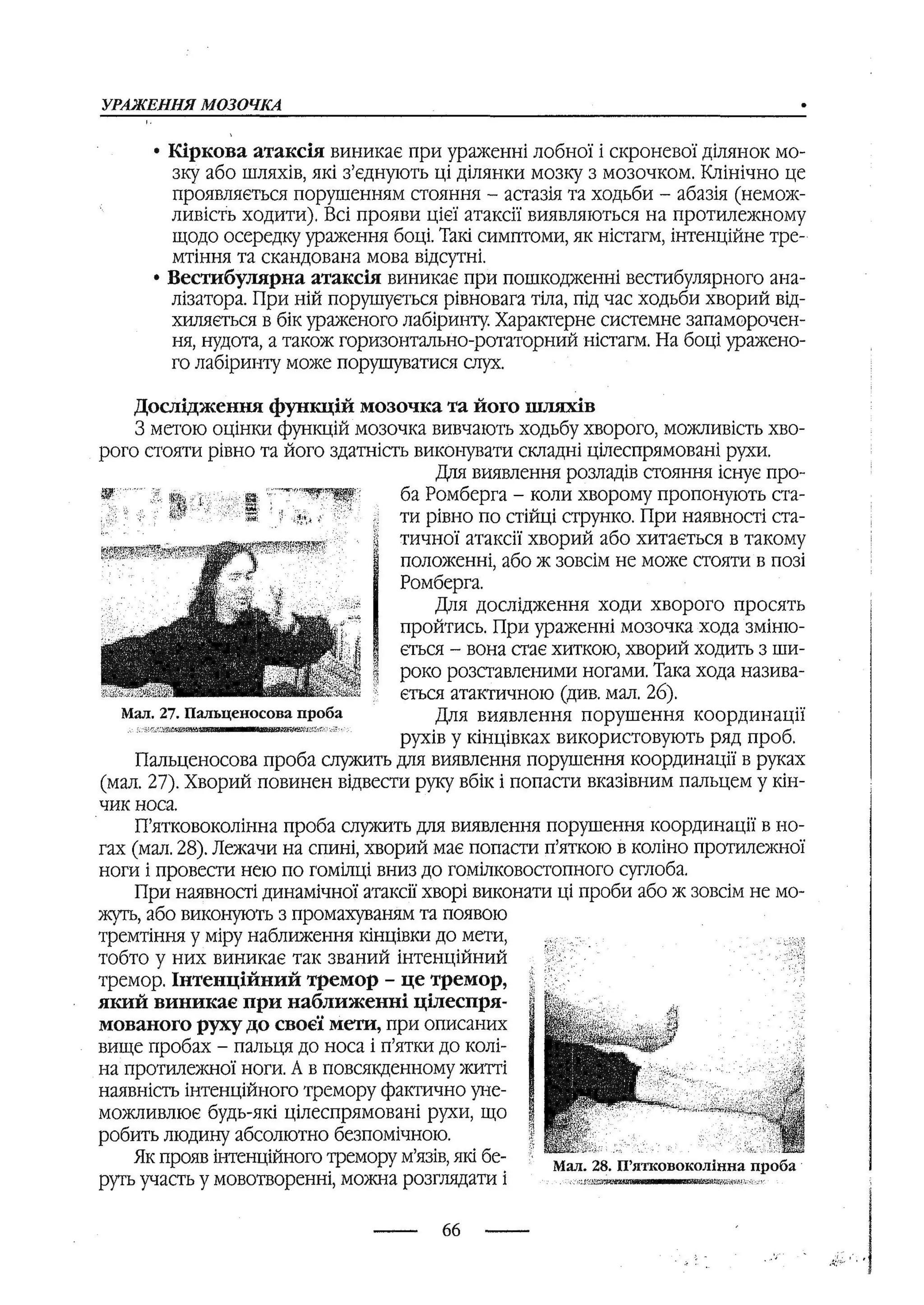 медсестринство в неврології за ред. В.М. Пашковський, І.І. Кричун, І.І. Кривецька, І.Я. ст.254 , 2003р
