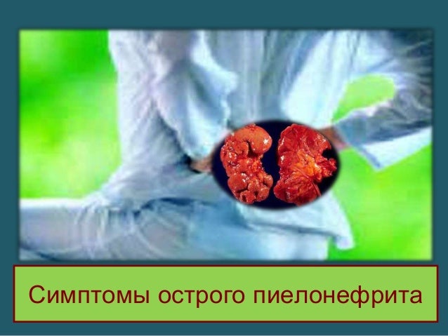 пиелонефрит