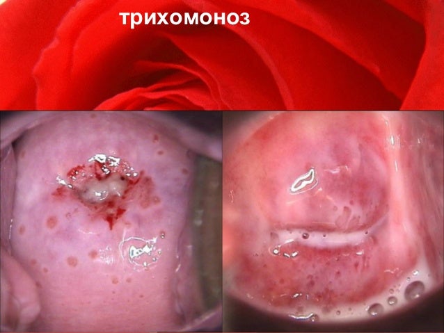 Мази и гели для сужения влагалища