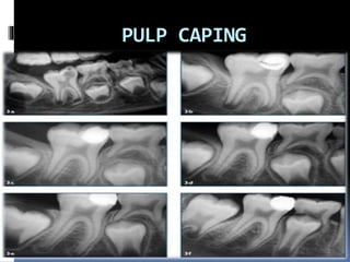 PULP CAPING
 