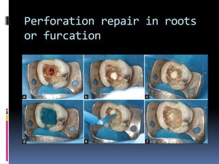Perforation repair in roots
or furcation
 