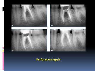 Perforation repair
 