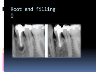 Root end filling
0
 