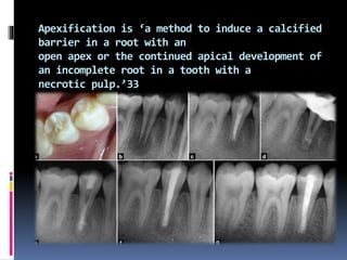 Apexification is ‘a method to induce a calcified
barrier in a root with an
open apex or the continued apical development of
an incomplete root in a tooth with a
necrotic pulp.’33
 