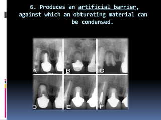 6. Produces an artificial barrier,
against which an obturating material can
be condensed.
 