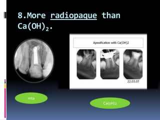 8.More radiopaque than
Ca(OH)2.
mta
Ca(oH)2
 