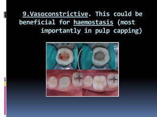 9.Vasoconstrictive. This could be
beneficial for haemostasis (most
importantly in pulp capping)
 