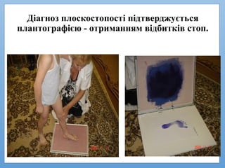 Діагноз плоскостопості підтверджується
плантографією - отриманням відбитків стоп.
 