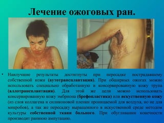 • Наилучшие результаты достигнуты при пересадке пострадавшему
собственной кожи (аутотрансплантация). При обширных ожогах можно
использовать специально обработанную и консервированную кожу трупа
(аллотрансплантация). Для этой же цели можно использовать
консервированную кожу эмбриона (брефопластика) или искуственную кожу
(из слоя коллагена и силиконовой пленки проницаемой для воздуха, но не для
микробов), а так же пересадку выращенного в искуственной среде методом
культуры собственной ткани больного. При обугливании конечности
производят раннюю ампутацию.
Лечение ожоговых ран.
 