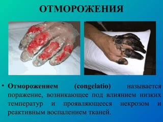 ОТМОРОЖЕНИЯ
• Отморожением (congelatio) называется
поражение, возникающее под влиянием низких
температур и проявляющееся некрозом и
реактивным воспалением тканей.
 