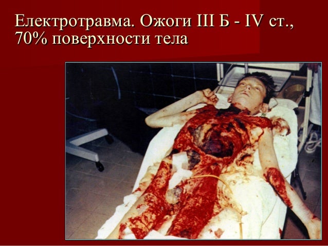 фото ожогов 90 тела онлайн фото ожогов 90 тела