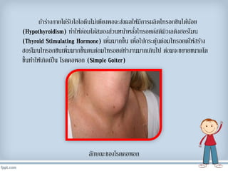 ถ้ำร่ำงกำยได้รับไอโอดีนไม่เพียงพอจะส่งผลให้มีกำรผลิตไทรอกซินได้น้อย
(Hypothyroidism) ทำให้ต่อมใต้สมองส่วนหน้ำหลั่งไทรอยด์สติมิวเลติงฮอร์โมน
(Thyroid Stimulating Hormone) เพิ่มมำกขึ้น เพื่อไปกระตุ้นต่อมไทรอยด์ให้สร้ำง
ฮอร์โมนไทรอกซินเพิ่มมำกขึ้นตนต่อมไทรอยด์ทำงำนมำกเกินไป ต่อมจะขยำยขนำดโต
ขึ้นทำให้เกิดเป็น โรคคอพอก (Simple Goiter)
ลักษณะของโรคคอพอก
 