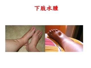 下肢水腫
 