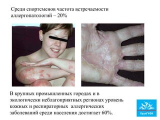 Среди спортсменов частота встречаемости
аллергопатологий – 20%
В крупных промышленных городах и в
экологически неблагоприятных регионах уровень
кожных и респираторных аллергических
заболеваний среди населения достигает 60%.
 