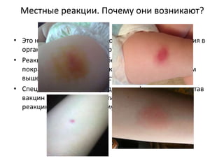 Местные реакции. Почему они возникают?
• Это нормально – реакция воспаления в месте введения в
организм чужеродных микробов
• Реакция на укол сам по себе (припухлость, отек,
покраснение возникнут даже на введение воды) – тем
выше, чем более поверхностный укол
• Специальные вещества (гидроокись ), входящие в состав
вакцин (АКДС, против гепатита) усиливают местную
реакцию для усиления иммунного ответа
 