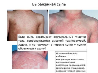 Выраженная сыпь
Если сыпь охватывает значительные участки
тела, сопровождается высокой температурой,
зудом, и не проходит в первые сутки – нужно
обратиться к врачу!
Осложнений можно
избежать:
консультация аллерголога,
предпрививочная
подготовка, прививка детей
группы риска стационарно,
проверка условий хранения
 
