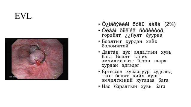 элэгний циррозын цус алдалт