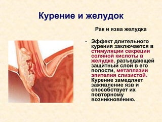 Курение и желудок
Рак и язва желудка
- Эффект длительного
курения заключается в
стимуляции секреции
соляной кислоты в
желудке, разъедающей
защитный слой в его
полости, метаплазии
эпителия слизистой.
Курение замедляет
заживление язв и
способствует их
повторному
возникновению.
 