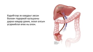 Хэдийгээр эх хавдрыг авсан
боловч тодорхой хугацааны
дараа хавдар дахих, эсвэл алсын
үсэрхийлэл өгөх нь олон.
 