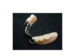 съёмные протезы