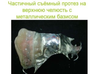 съёмные протезы