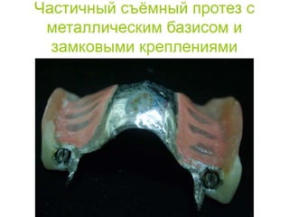 съёмные протезы