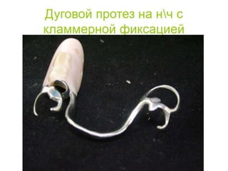 съёмные протезы