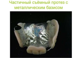 съёмные протезы