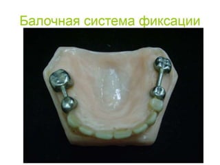 съёмные протезы