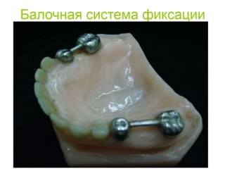 съёмные протезы