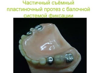 съёмные протезы