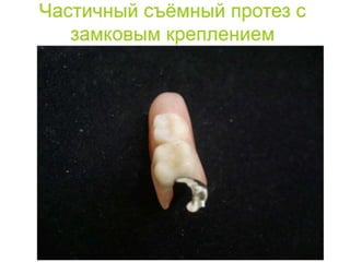 съёмные протезы