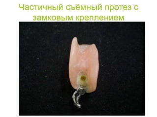 съёмные протезы