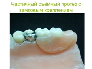 съёмные протезы