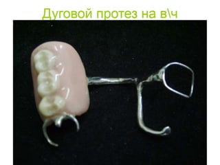 съёмные протезы