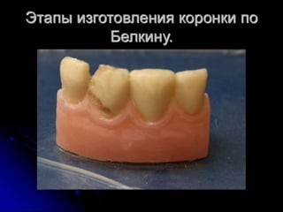 несьёмные протезы