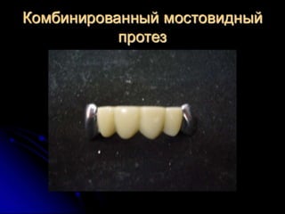 несьёмные протезы