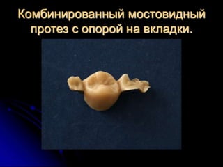 несьёмные протезы