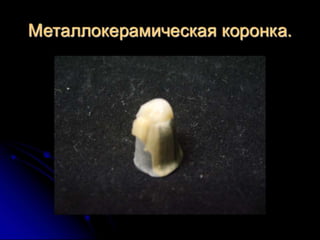 несьёмные протезы