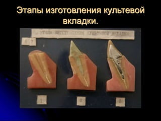 несьёмные протезы