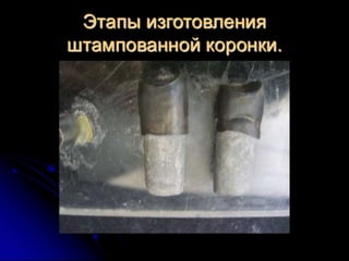 несьёмные протезы