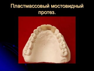 несьёмные протезы