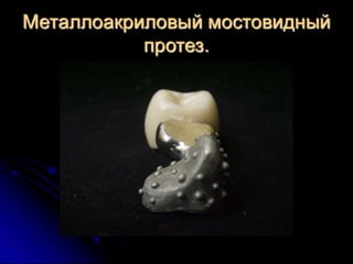 несьёмные протезы