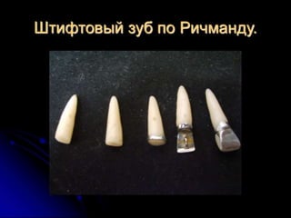 несьёмные протезы