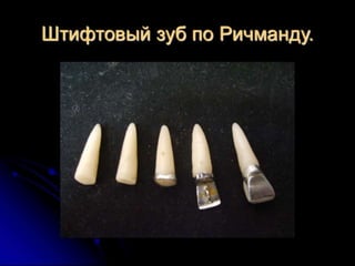 несьёмные протезы