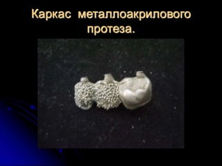 несьёмные протезы