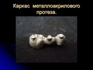 несьёмные протезы